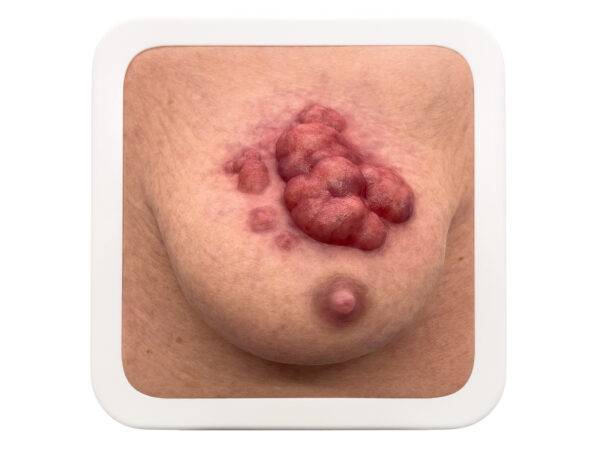 Das „Rahmenmodell Ulcerierendes Mamma-CA (Brusttumor)“ von MEDICAL FX Germany bietet eine detaillierte Darstellung eines ulcerierenden Brusttumors. Es ist in einen robusten, weiße…