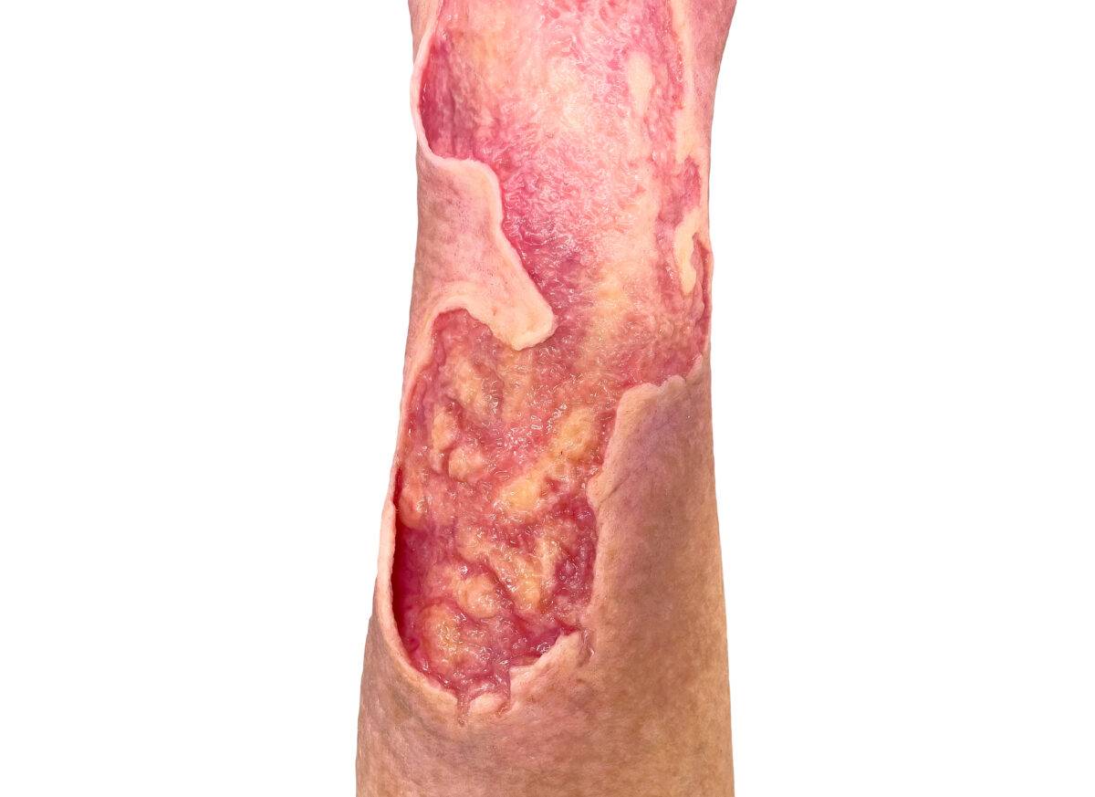 Das Wundmodell „Sleeve Bein mit Gamaschenulkus“ von MEDICAL FX Germany ist ein hochspezialisiertes Trainingswerkzeug, das für das medizinische Training zur Behandlung von venösen…