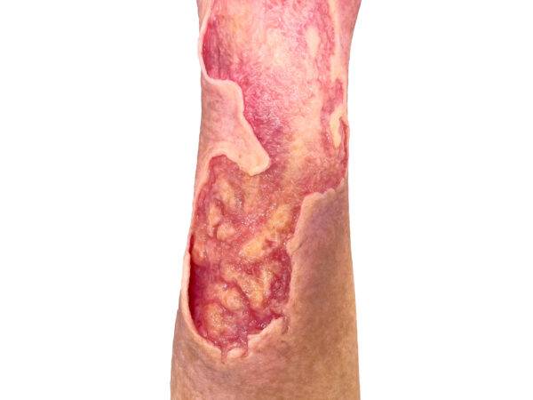 Das Wundmodell „Sleeve Bein mit Gamaschenulkus“ von MEDICAL FX Germany ist ein hochspezialisiertes Trainingswerkzeug, das für das medizinische Training zur Behandlung von venösen…