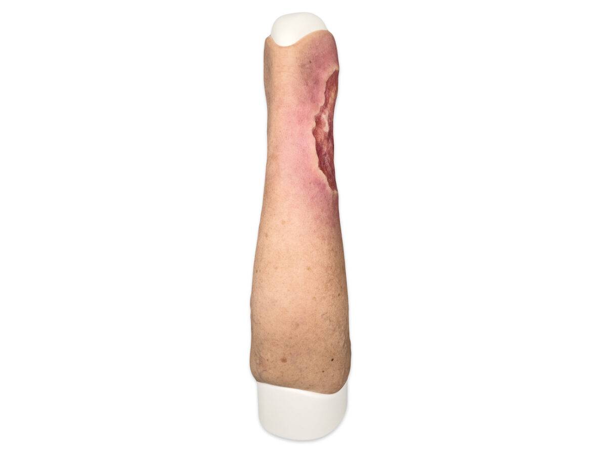Das Wundmodell „Sleeve Bein mit Ulcus Cruris“ von MEDICAL FX Germany aus hochwertigem Silikon ermöglicht eine blitzschnelle Anwendung auf Trainingsphantomen. Diese praktische Kons…