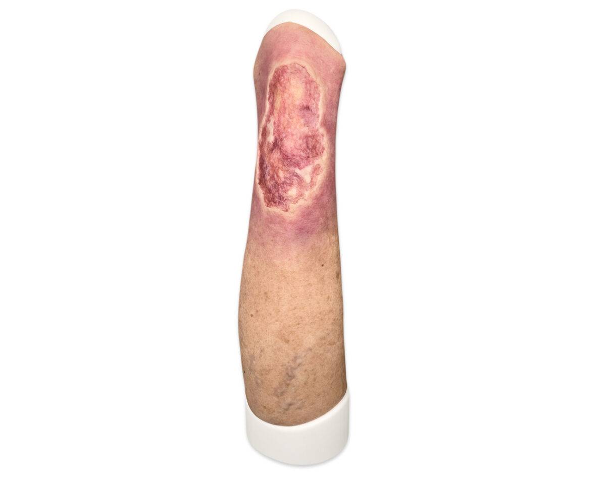 Das Wundmodell „Sleeve Bein mit Ulcus Cruris“ von MEDICAL FX Germany aus hochwertigem Silikon ermöglicht eine blitzschnelle Anwendung auf Trainingsphantomen. Diese praktische Kons…