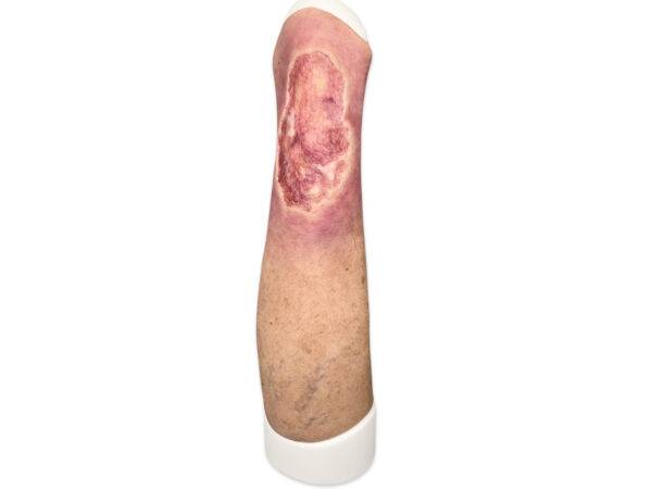 Das Wundmodell „Sleeve Bein mit Ulcus Cruris“ von MEDICAL FX Germany aus hochwertigem Silikon ermöglicht eine blitzschnelle Anwendung auf Trainingsphantomen. Diese praktische Kons…
