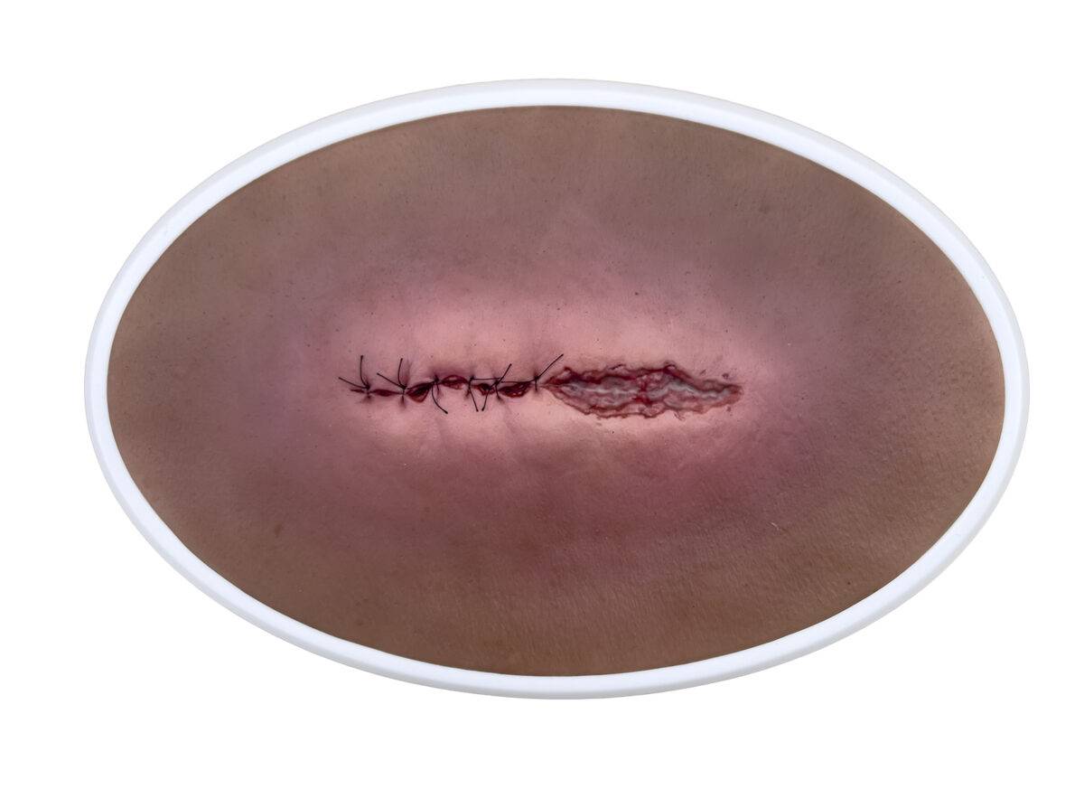 Das „Rahmenmodell OP-Wunde Geöffnet" von MEDICAL FX Germany bietet eine realistische Darstellung einer chirurgischen Wunde in geöffnetem Zustand. Dieses Modell ist in einen robust…