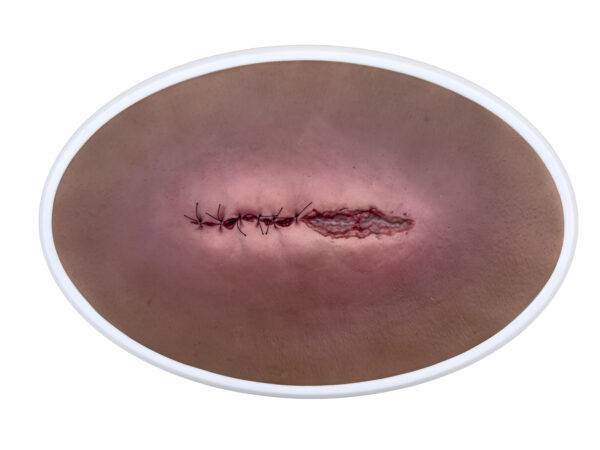 Das „Rahmenmodell OP-Wunde Geöffnet" von MEDICAL FX Germany bietet eine realistische Darstellung einer chirurgischen Wunde in geöffnetem Zustand. Dieses Modell ist in einen robust…