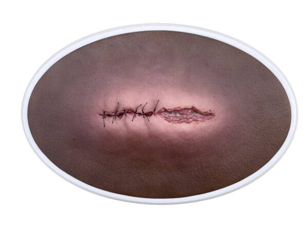 Das „Rahmenmodell OP-Wunde Geöffnet" von MEDICAL FX Germany bietet eine realistische Darstellung einer chirurgischen Wunde in geöffnetem Zustand. Dieses Modell ist in einen robust…