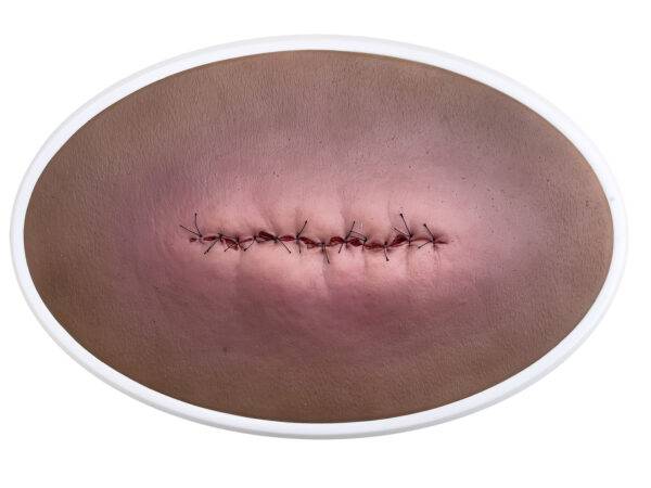 Das „Rahmenmodell OP-Wunde Geschlossen und Entzündet“ von MEDICAL FX Germany illustriert eine postoperative Wunde, die geschlossen ist, jedoch Anzeichen einer Entzündung zeigt. Ei…