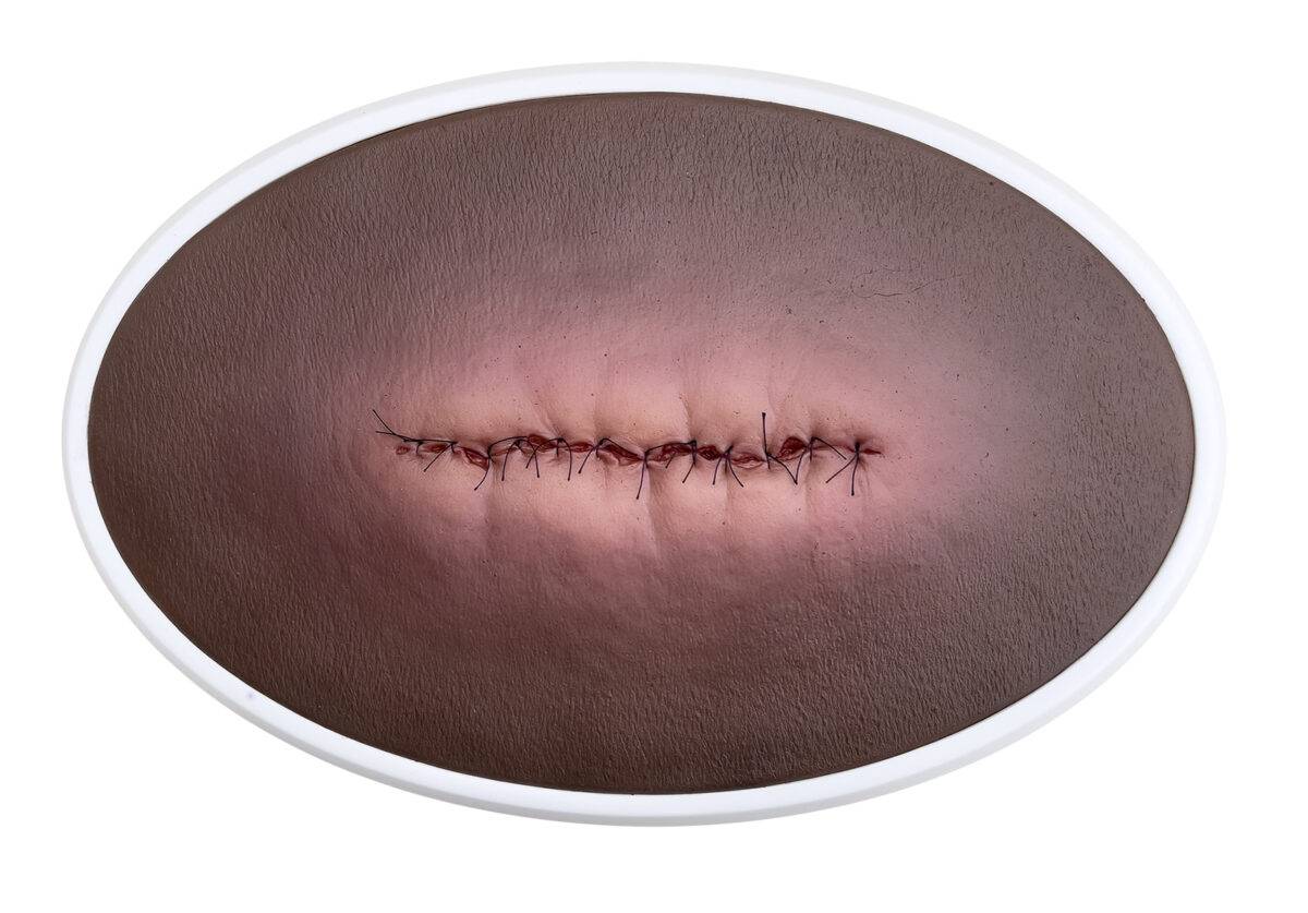 Das „Rahmenmodell OP-Wunde Geschlossen und Entzündet“ von MEDICAL FX Germany illustriert eine postoperative Wunde, die geschlossen ist, jedoch Anzeichen einer Entzündung zeigt. Ei…