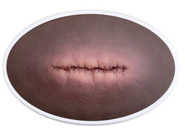 Das „Rahmenmodell OP-Wunde Geschlossen und Entzündet“ von MEDICAL FX Germany illustriert eine postoperative Wunde, die geschlossen ist, jedoch Anzeichen einer Entzündung zeigt. Ei…