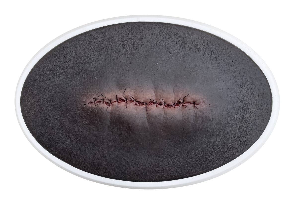 Das „Rahmenmodell OP-Wunde Geschlossen und Entzündet“ von MEDICAL FX Germany illustriert eine postoperative Wunde, die geschlossen ist, jedoch Anzeichen einer Entzündung zeigt. Ei…