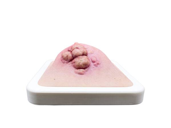 Das „Rahmenmodell Ulcerierendes Mamma-CA (Brusttumor)“ von MEDICAL FX Germany bietet eine detaillierte Darstellung eines ulcerierenden Brusttumors. Es ist in einen robusten, weiße…