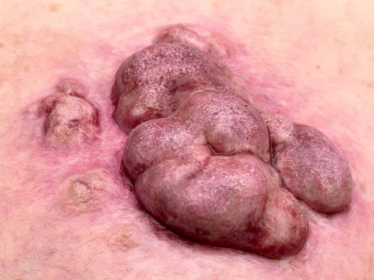 Das „Rahmenmodell Ulcerierendes Mamma-CA (Brusttumor)“ von MEDICAL FX Germany bietet eine detaillierte Darstellung eines ulcerierenden Brusttumors. Es ist in einen robusten, weiße…