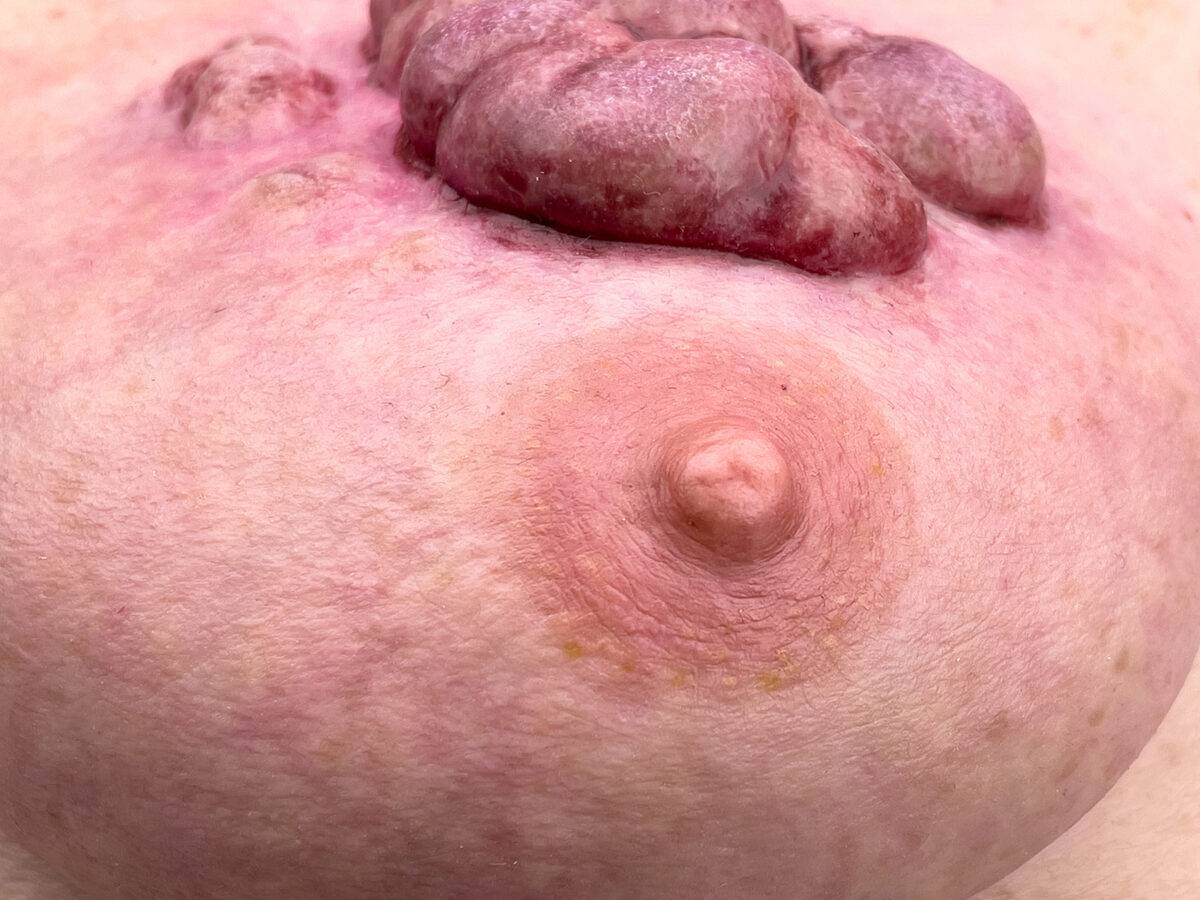 Das „Rahmenmodell Ulcerierendes Mamma-CA (Brusttumor)“ von MEDICAL FX Germany bietet eine detaillierte Darstellung eines ulcerierenden Brusttumors. Es ist in einen robusten, weiße…