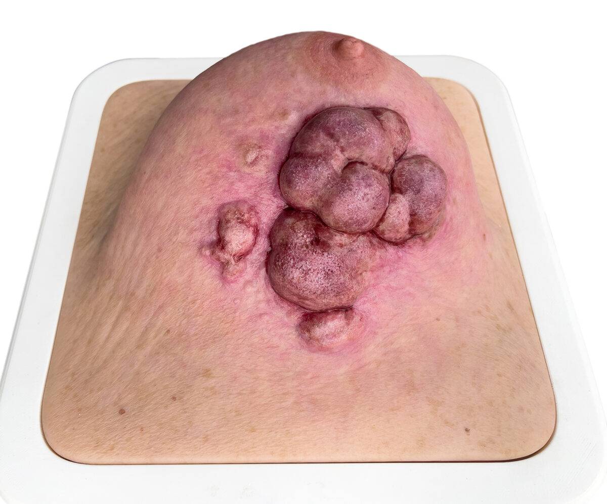 Das „Rahmenmodell Ulcerierendes Mamma-CA (Brusttumor)“ von MEDICAL FX Germany bietet eine detaillierte Darstellung eines ulcerierenden Brusttumors. Es ist in einen robusten, weiße…