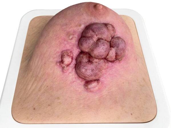 Das „Rahmenmodell Ulcerierendes Mamma-CA (Brusttumor)“ von MEDICAL FX Germany bietet eine detaillierte Darstellung eines ulcerierenden Brusttumors. Es ist in einen robusten, weiße…