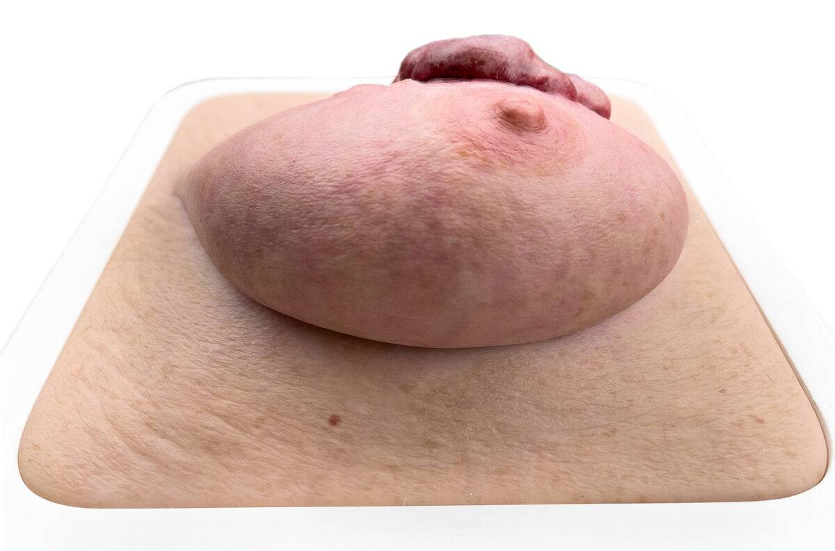 Das „Rahmenmodell Ulcerierendes Mamma-CA (Brusttumor)“ von MEDICAL FX Germany bietet eine detaillierte Darstellung eines ulcerierenden Brusttumors. Es ist in einen robusten, weiße…