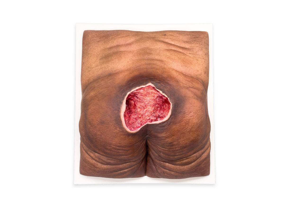 Das „Rahmenmodell Gesäß-Dekubitus" von MEDICAL FX Germany ist eine präzise Nachbildung eines fortgeschrittenen Druckgeschwürs im Sakralbereich, gefertigt aus hochwertigem Silikon.…