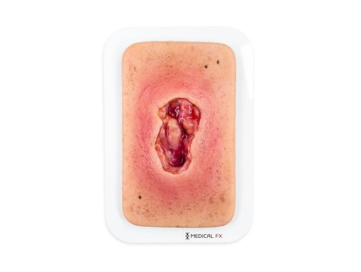 Das Modell „Pocketwunde Dekubitus" von MEDICAL FX Germany stellt eine realistische Nachbildung eines Druckgeschwürs dar, typisch für bettlägerige Patienten. Diese kompakte Simulat…