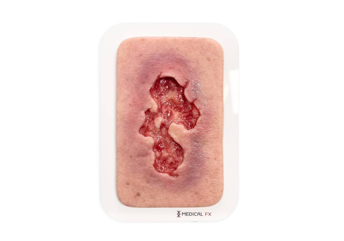 Das Modell „Pocketwunde Ulcer - Chronische Wunde" von MEDICAL FX Germany zeigt eine realistische Simulation eines chronischen Ulcus. Diese kompakte Wundnachbildung ist auf einer s…