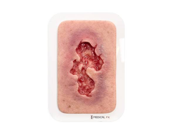 Das Modell „Pocketwunde Ulcer - Chronische Wunde" von MEDICAL FX Germany zeigt eine realistische Simulation eines chronischen Ulcus. Diese kompakte Wundnachbildung ist auf einer s…