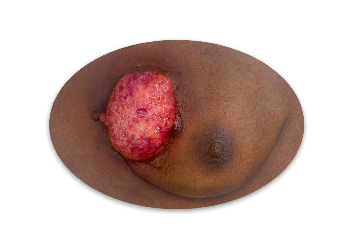 STM 06 0028 00 03 Brusttumor mamma ca stick on medicalfx germany LQ