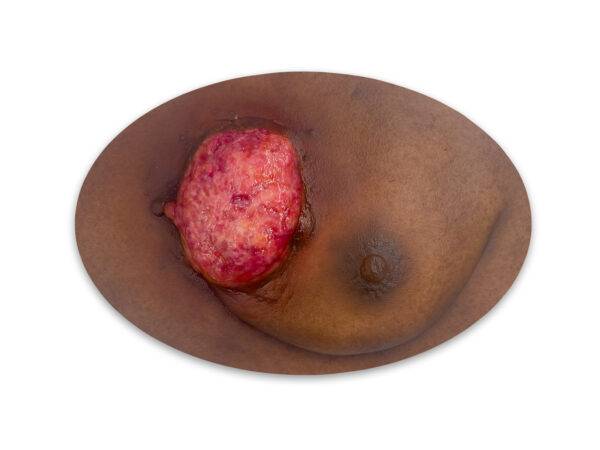 STM 06 0028 00 03 Brusttumor mamma ca stick on medicalfx germany LQ