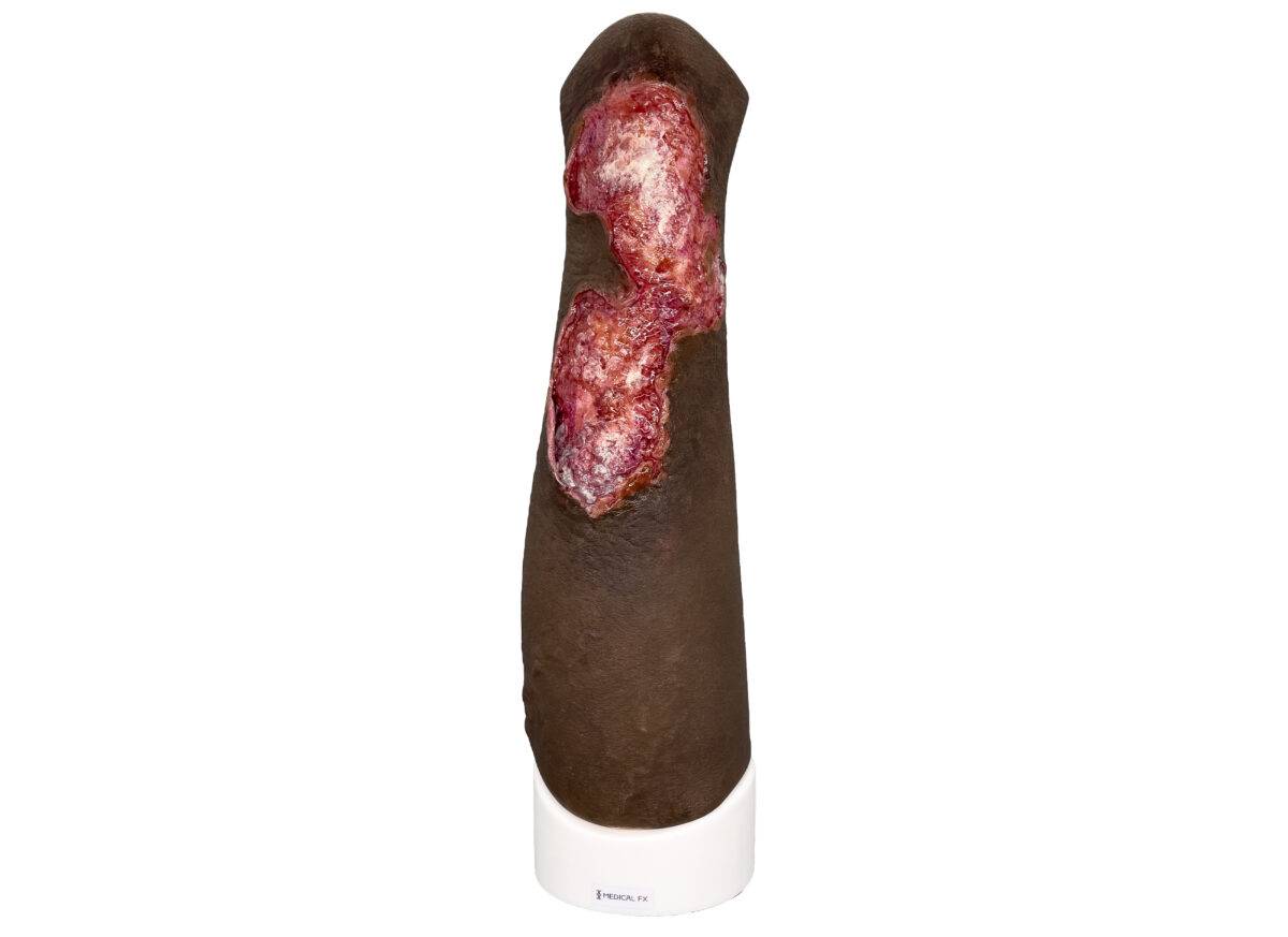 Sleeve Bein mit Gamaschenulkus farbe 4 medicalfx