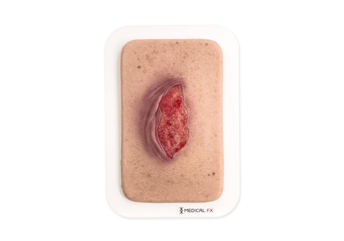 Das kompakte Modell „Pocketwunde Ablederung (Skin tears)“ von MEDICAL FX Germany, etwa in der Größe eines Smartphones, stellt eine realistische Nachbildung von Skin Tears dar. Die…