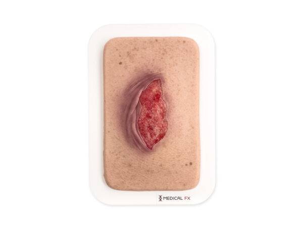 Das kompakte Modell „Pocketwunde Ablederung (Skin tears)“ von MEDICAL FX Germany, etwa in der Größe eines Smartphones, stellt eine realistische Nachbildung von Skin Tears dar. Die…