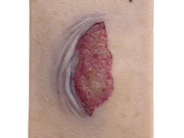 lq 1 pocketwunden ablederung