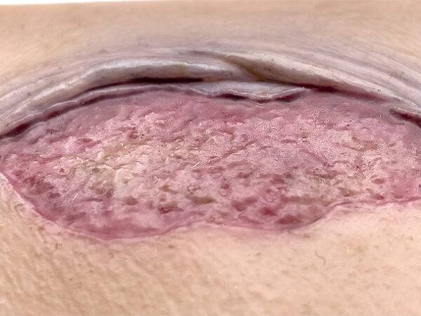 Das kompakte Modell „Pocketwunde Ablederung (Skin tears)“ von MEDICAL FX Germany, etwa in der Größe eines Smartphones, stellt eine realistische Nachbildung von Skin Tears dar. Die…