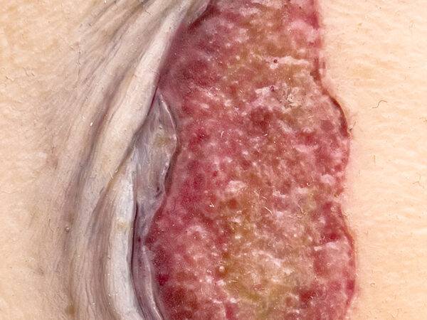 Das kompakte Modell „Pocketwunde Ablederung (Skin tears)“ von MEDICAL FX Germany, etwa in der Größe eines Smartphones, stellt eine realistische Nachbildung von Skin Tears dar. Die…