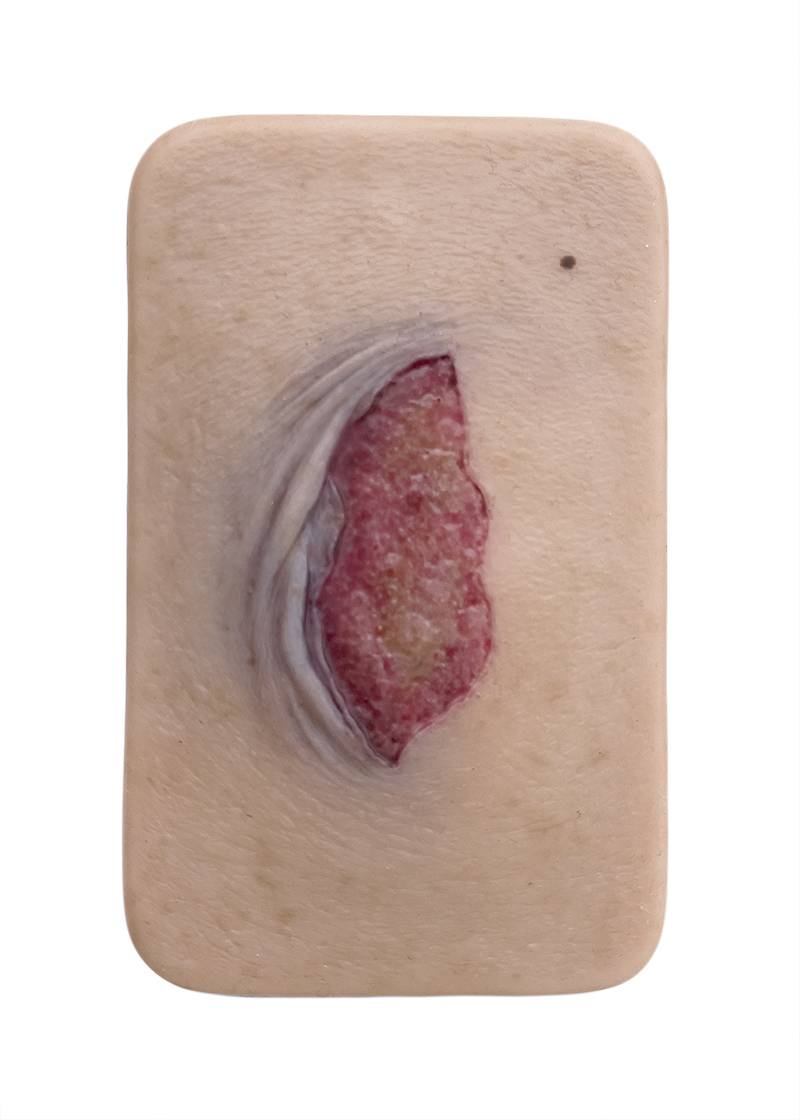 lq 1 pocketwunden ablederung