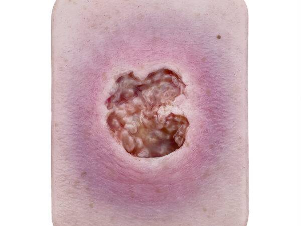 Das Wundmodell „Pocketwunde Ulcer mit größerer Wundumgebung“ von MEDICAL FX Germany zeichnet sich durch eine umfangreiche Darstellung einer Ulcuswunde mit einer ausgedehnten Wundu…