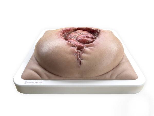 Das „Rahmenmodell Platzbauch" von MEDICAL FX Germany bietet eine realistische Simulation einer postoperativen Nahtdehiszenz, bei der chirurgische Nähte einer frisch verschlossenen…