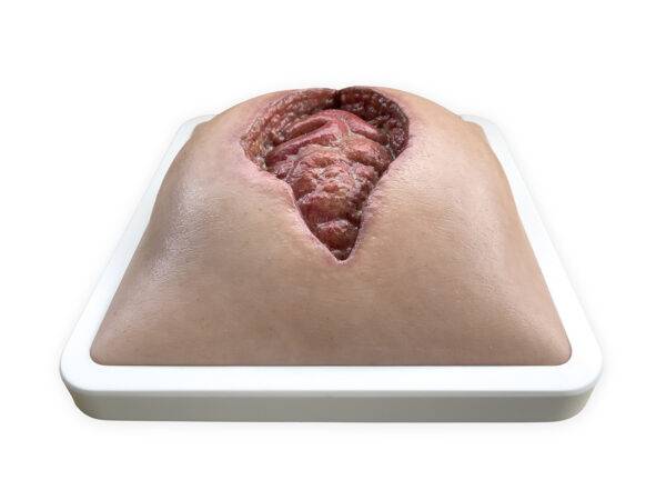 Das „Rahmenmodell Platzbauch" von MEDICAL FX Germany bietet eine realistische Simulation einer postoperativen Nahtdehiszenz, bei der chirurgische Nähte einer frisch verschlossenen…