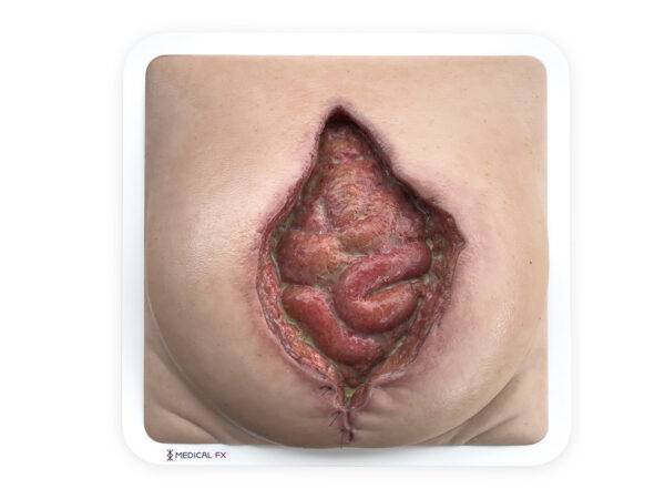 Das „Rahmenmodell Platzbauch" von MEDICAL FX Germany bietet eine realistische Simulation einer postoperativen Nahtdehiszenz, bei der chirurgische Nähte einer frisch verschlossenen…