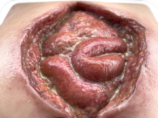 Das „Rahmenmodell Platzbauch" von MEDICAL FX Germany bietet eine realistische Simulation einer postoperativen Nahtdehiszenz, bei der chirurgische Nähte einer frisch verschlossenen…