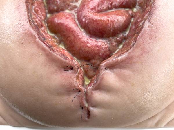 Das „Rahmenmodell Platzbauch" von MEDICAL FX Germany bietet eine realistische Simulation einer postoperativen Nahtdehiszenz, bei der chirurgische Nähte einer frisch verschlossenen…