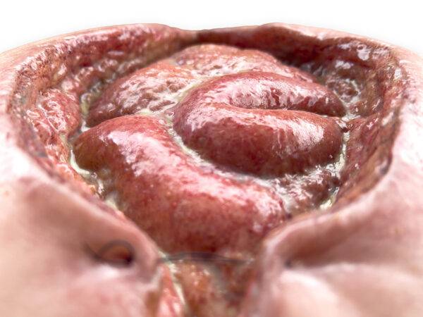 Das „Rahmenmodell Platzbauch" von MEDICAL FX Germany bietet eine realistische Simulation einer postoperativen Nahtdehiszenz, bei der chirurgische Nähte einer frisch verschlossenen…