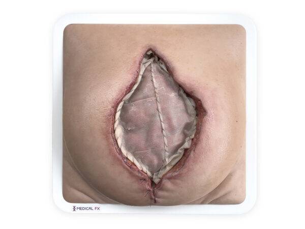 Das „Rahmenmodell Platzbauch" von MEDICAL FX Germany bietet eine realistische Simulation einer postoperativen Nahtdehiszenz, bei der chirurgische Nähte einer frisch verschlossenen…