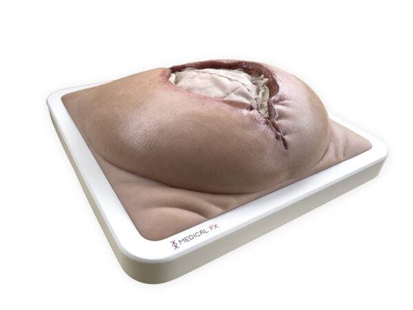 Das „Rahmenmodell Platzbauch" von MEDICAL FX Germany bietet eine realistische Simulation einer postoperativen Nahtdehiszenz, bei der chirurgische Nähte einer frisch verschlossenen…