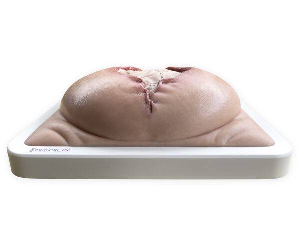 Das „Rahmenmodell Platzbauch" von MEDICAL FX Germany bietet eine realistische Simulation einer postoperativen Nahtdehiszenz, bei der chirurgische Nähte einer frisch verschlossenen…
