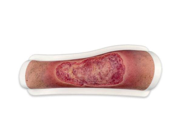 FR17 02 0047 00 1 Rahmenmodell Venous Leg Ulcer VLU venoeses Beingeschwuer LQ 1