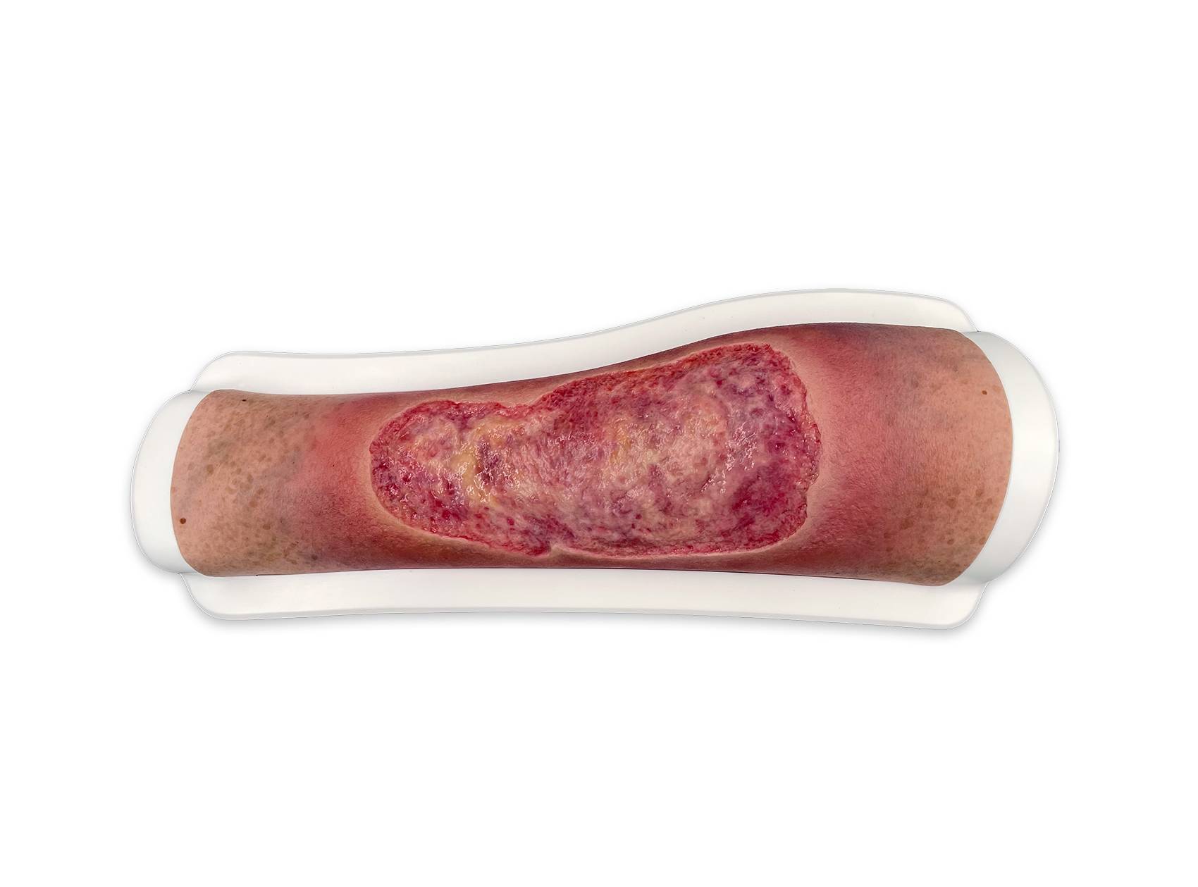 FR17 02 0047 00 1 Rahmenmodell Venous Leg Ulcer VLU venoeses Beingeschwuer LQ 1