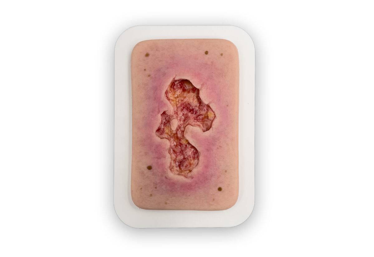 PW10 04 0053 01 1 Pocketwunde Ulcer Chronische Wunde 1 Kopie