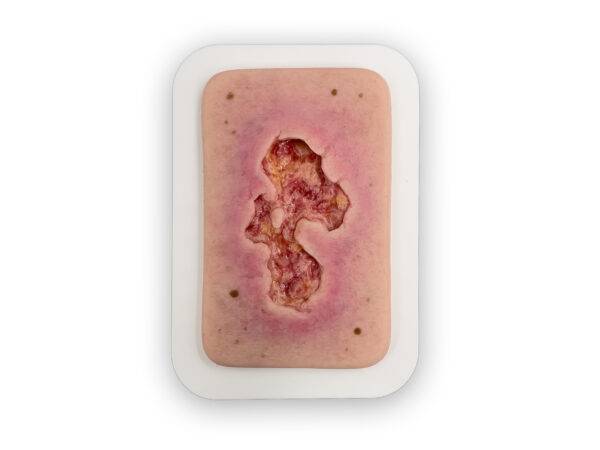 PW10 04 0053 01 1 Pocketwunde Ulcer Chronische Wunde 1 Kopie