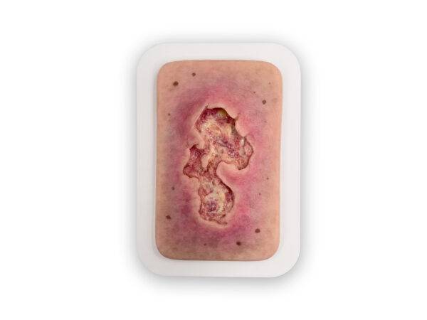 PW10 04 0053 01 1 Pocketwunde Ulcer Chronische Wunde mit Belag realistisches wundmodell silikonmodell Kopie