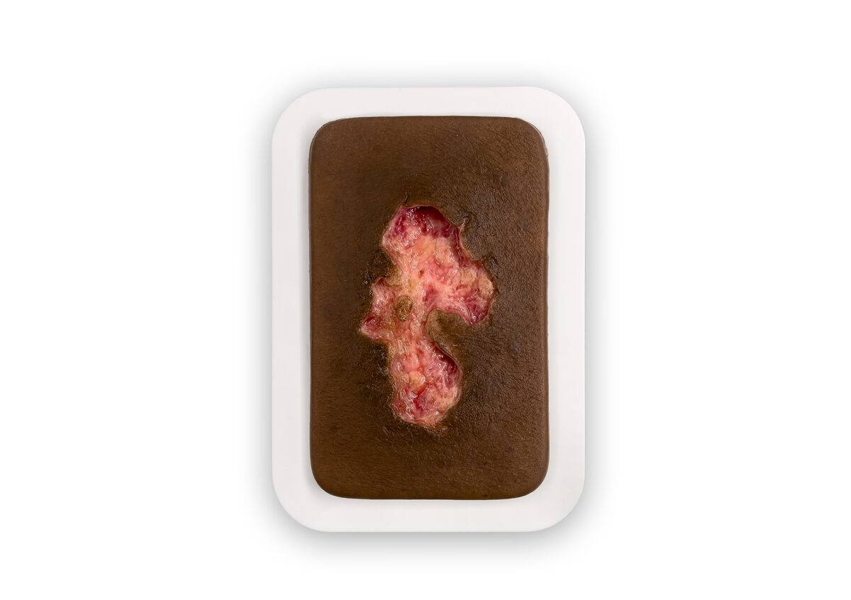 PW10 04 0053 01 3 Pocketwunde Ulcer Chronische Wunde Farbe 3 Kopie