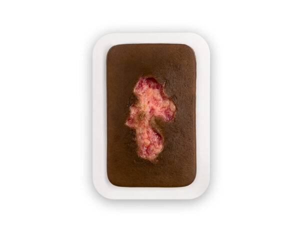 PW10 04 0053 01 3 Pocketwunde Ulcer Chronische Wunde Farbe 3 Kopie