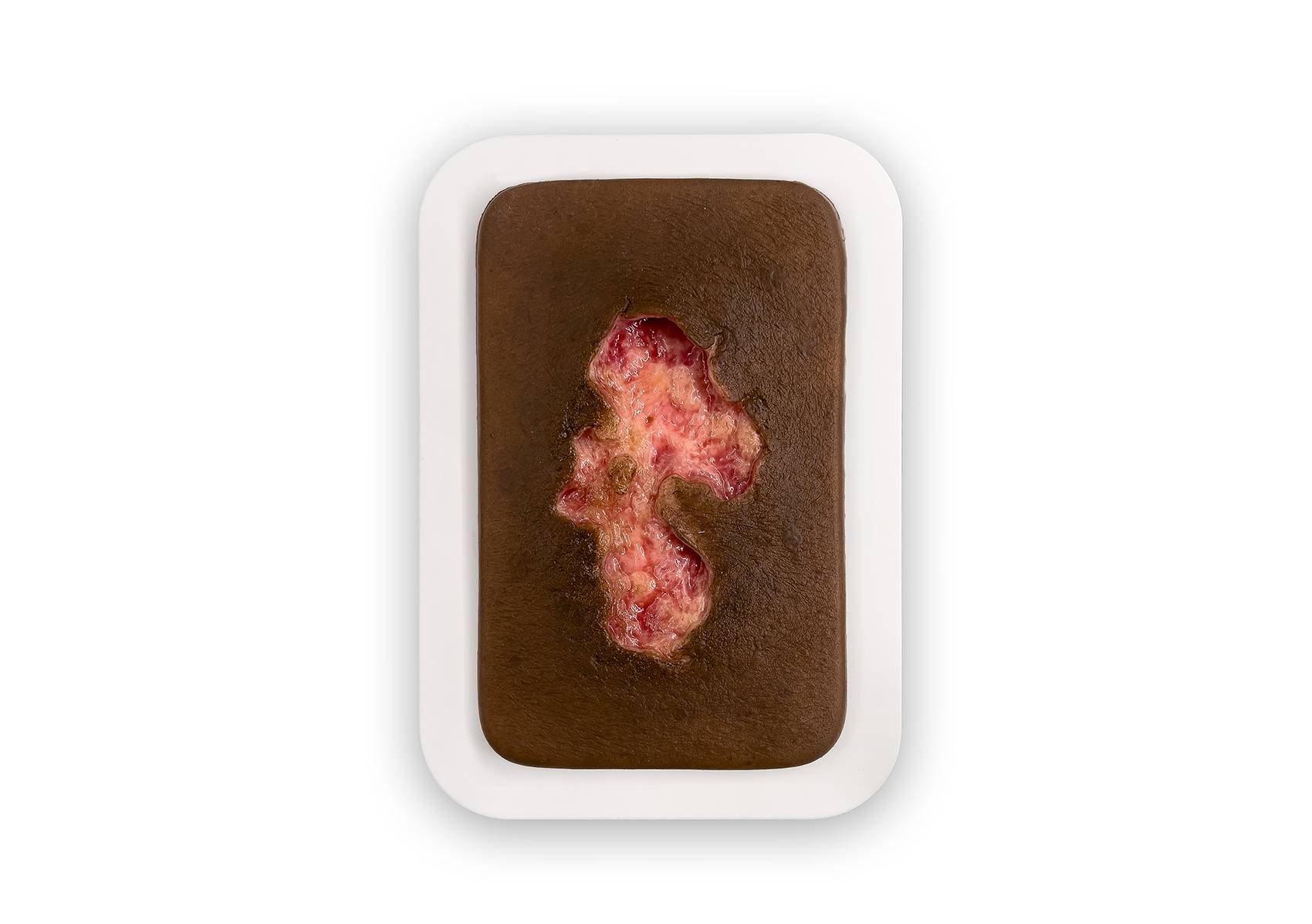 PW10 04 0053 01 3 Pocketwunde Ulcer Chronische Wunde Farbe 3 Kopie